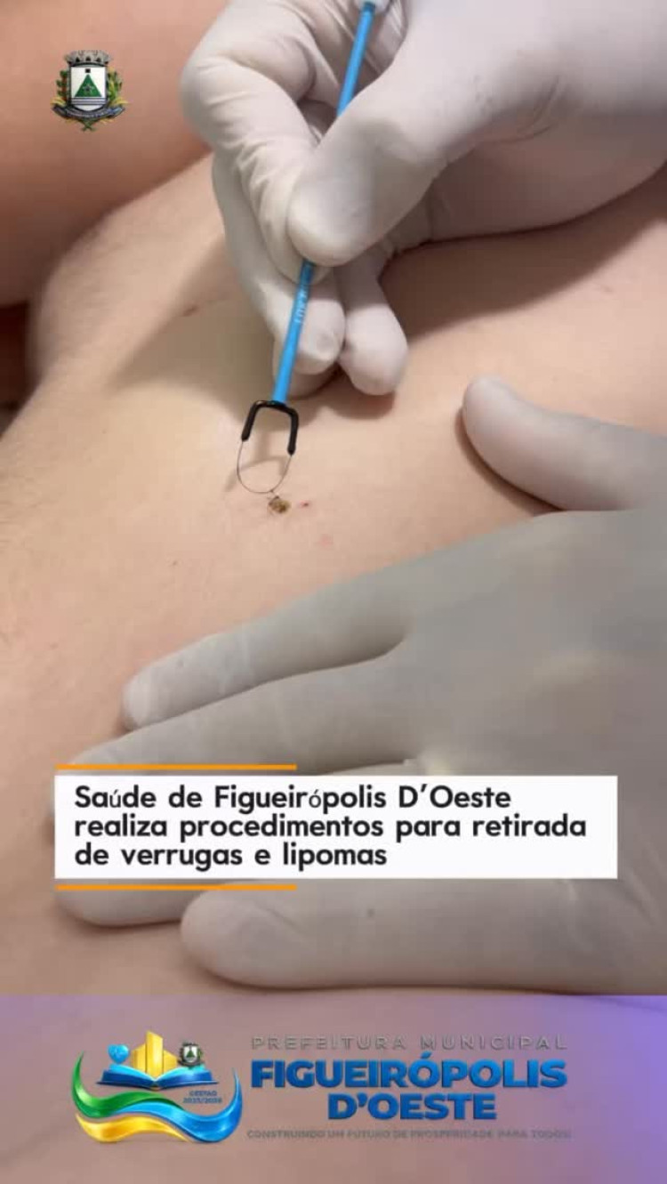 Pequenas cirurgias: retirada de verrugas e lipomas em Figueirópolis